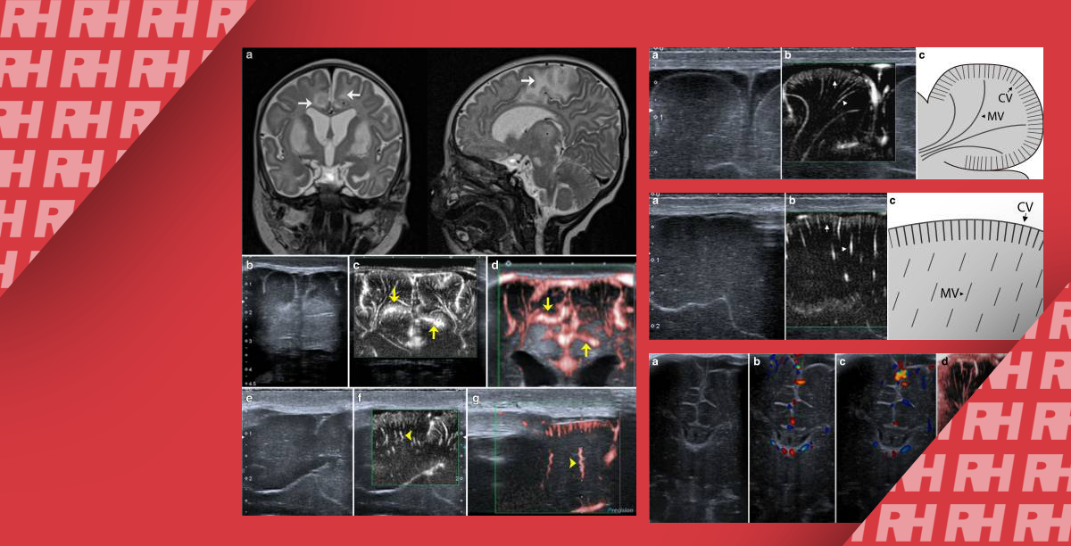 Микрососудистое УЗИ паренхимы головного мозга новорожденных: возможности, применение и нормальная визуализация с помощью SMI – Superb microvascular imaging - Статьи RH
