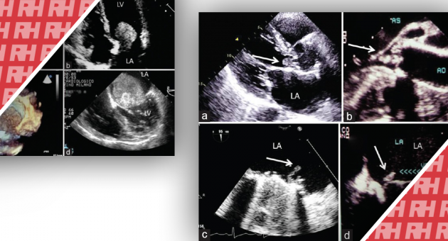 Роль и использование эхокардиографии в оценке сердечного источника эмболии. Часть вторая - Статьи RH