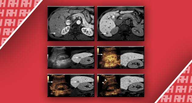 Применение Fusion Imaging для визуализации поражений печени - Статьи RH