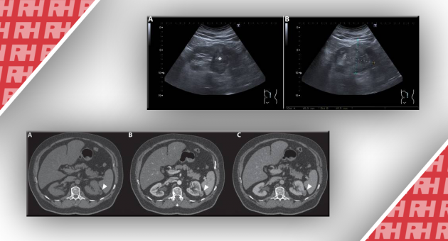 Диагностическая визуализация твердых опухолей почек - Статьи RH