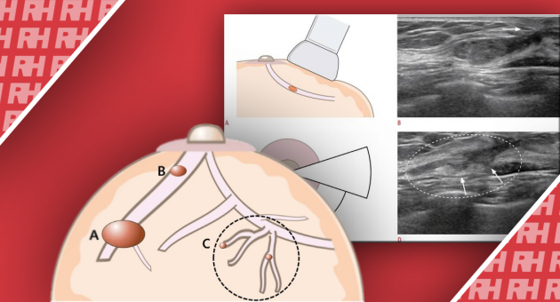 Ультразвуковая оценка женщин с патологическими выделениями из соска - Статьи RH