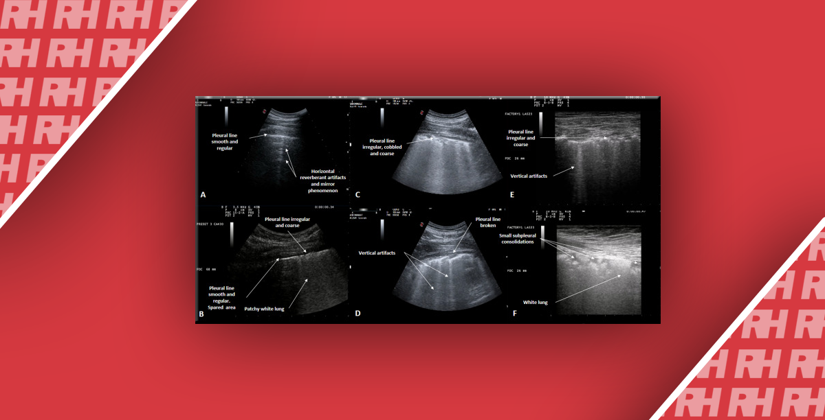 Ультразвуковое исследование легких для раннего ведения пациентов с респираторными симптомами во время пандемии COVID-19 - Статьи RH