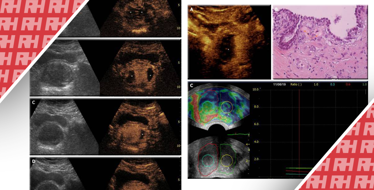 Ультразвуковая оценка эмболизации простатической артерии - Статьи RH