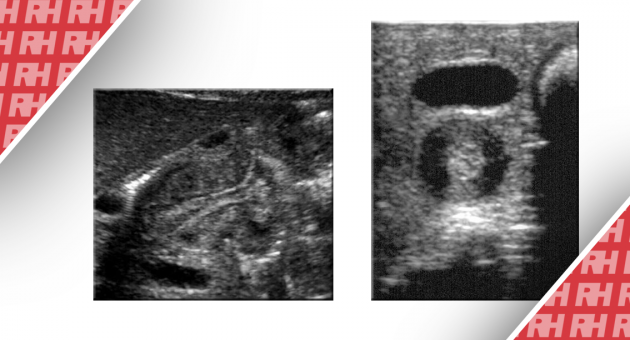 Визуализация при гипертрофическом стенозе привратника - Статьи RH