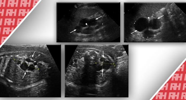 Подход к постнатальной сонографической оценке пренатально выявленных кист брюшной полости и малого таза. Часть вторая - Статьи RH