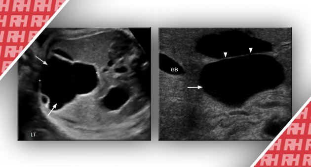 Подход к постнатальной сонографической оценке пренатально выявленных кист брюшной полости и малого таза. Часть первая - Статьи RH