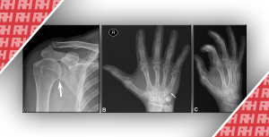 Повышение производительности и эффективности радиографического распознавания переломов с помощью искусственного интеллекта - Новини RH