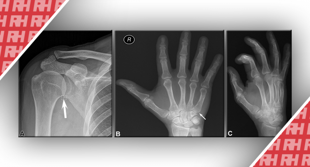 Повышение производительности и эффективности радиографического распознавания переломов с помощью искусственного интеллекта - Статьи RH