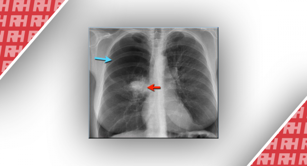 Рентгенологическая оценка лёгких: норма и патология. Часть третья - Статьи RH