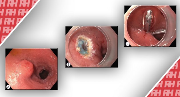 Роль эндоскопии при нейроэндокринных опухолях тонкой кишки - Статьи RH