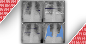 Оценка рентгенограммы грудной клетки отдельно или в сочетании с другими оценками риска для прогнозирования исходов при COVID-19 - Новини RH