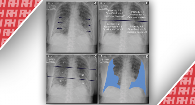 Оценка рентгенограммы грудной клетки отдельно или в сочетании с другими оценками риска для прогнозирования исходов при COVID-19 - Статьи RH