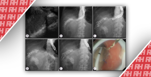 Эндоскопическая гастроэнтеростомия под ультразвуковым контролем при синдроме приводящей петли - Новини RH