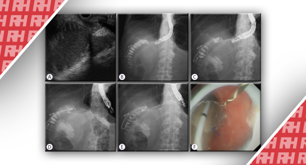 Эндоскопическая гастроэнтеростомия под ультразвуковым контролем при синдроме приводящей петли - Статьи RH